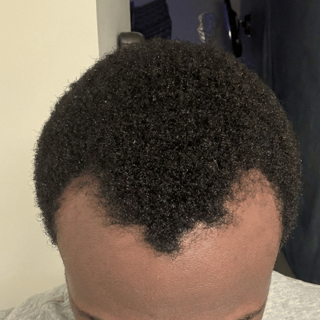 Aaron R.'s receding hairline at month one, then full again at month five