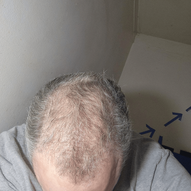 Donald P.'s thinning crown at month one, then thick again at month four