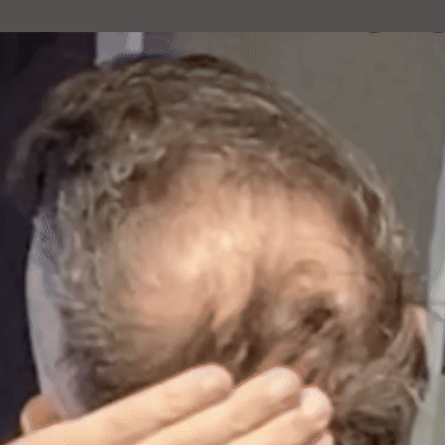 Jonathan G.'s bald crown at month one, then covered at month six