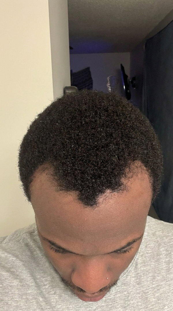 Aaron Reaves before Maneup Labs Restore