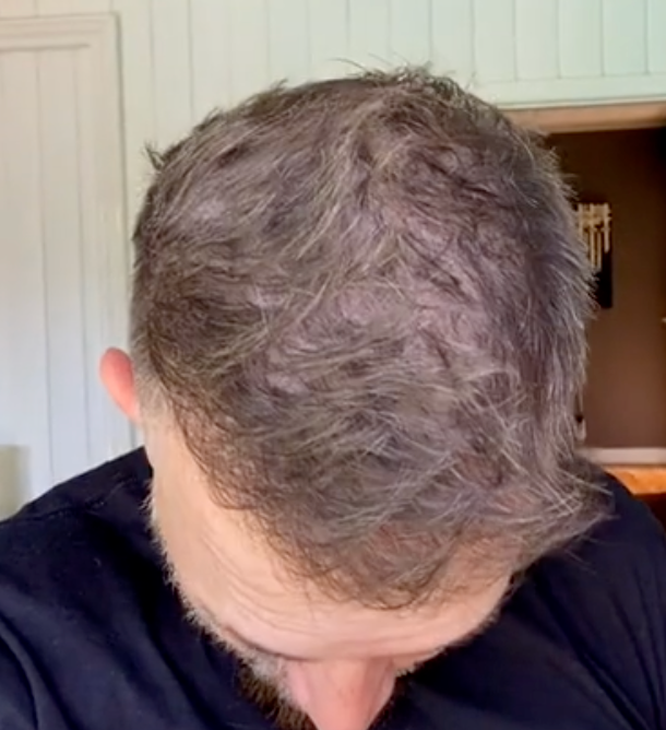 Jonathan's scalp six months in — crown filled back in, density restored