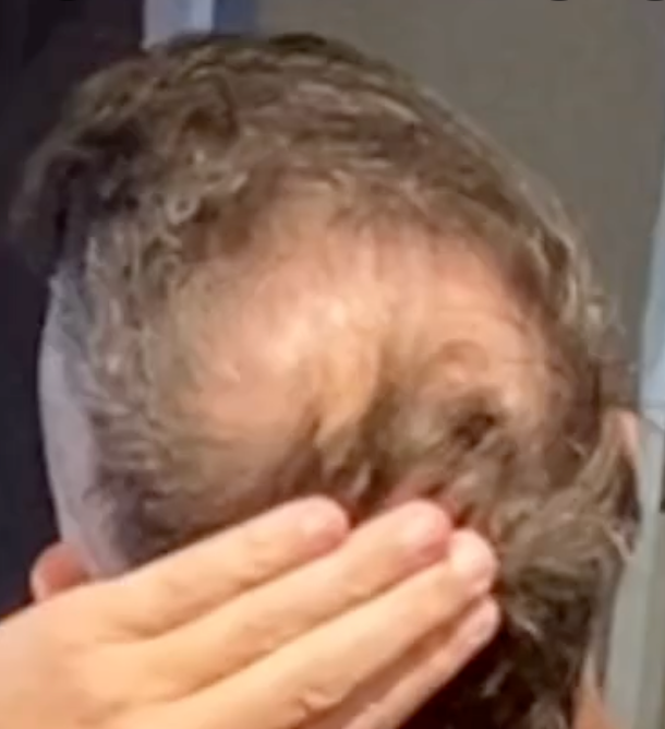 Top of Jonathan's head showing thinning crown and visible transplant scars